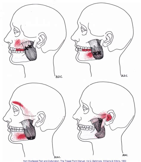 TMJ—Masseter Muscle—Compress an